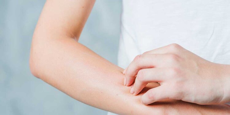 El diagnóstico tardío de la psoriasis impacta en el riesgo de enfermedades asociadas y la calidad de vida